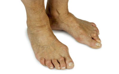 Bunions: Two Options for Bent Toe Joints